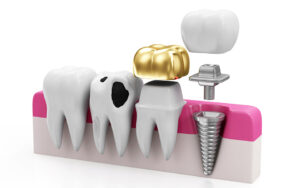 Restorative dentistry