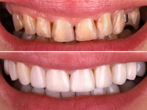 Restorative dentistry, dental restoration